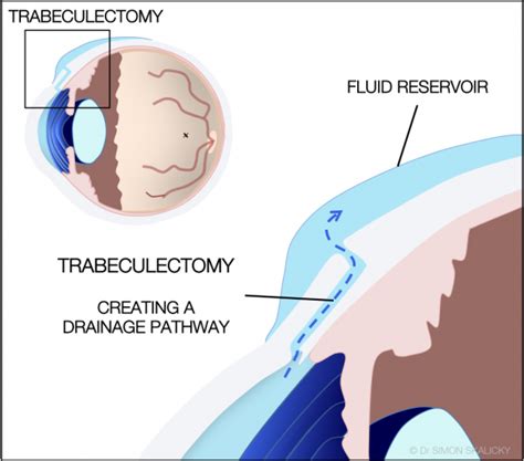 cpt code for trabeculectomy with mitomycin c|Diagnostic and Procedural Codes for Glaucoma and Glaucoma。